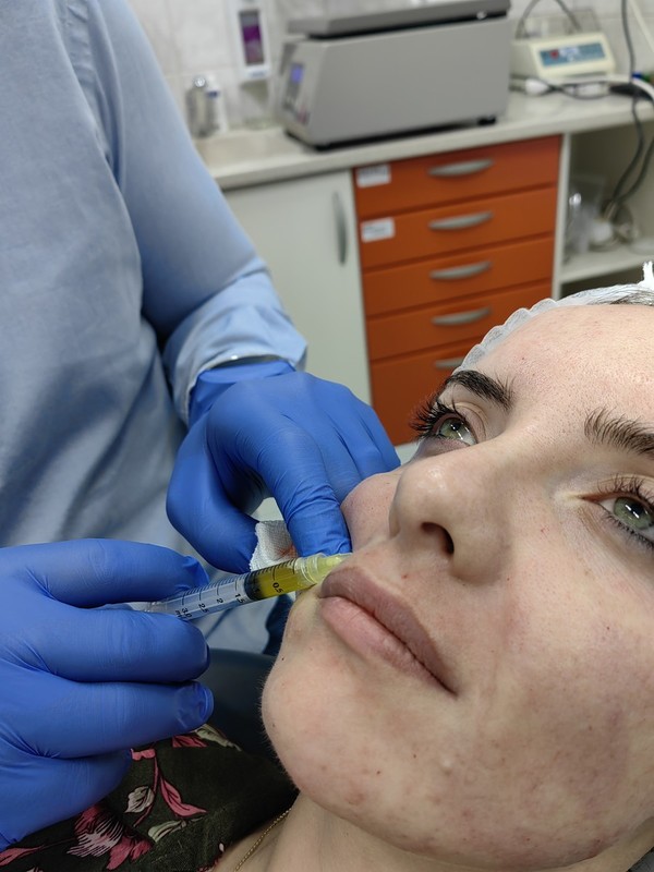 Pomlađivanje lica - Primjena plazme bogate faktorima rasta u estetskoj medicini