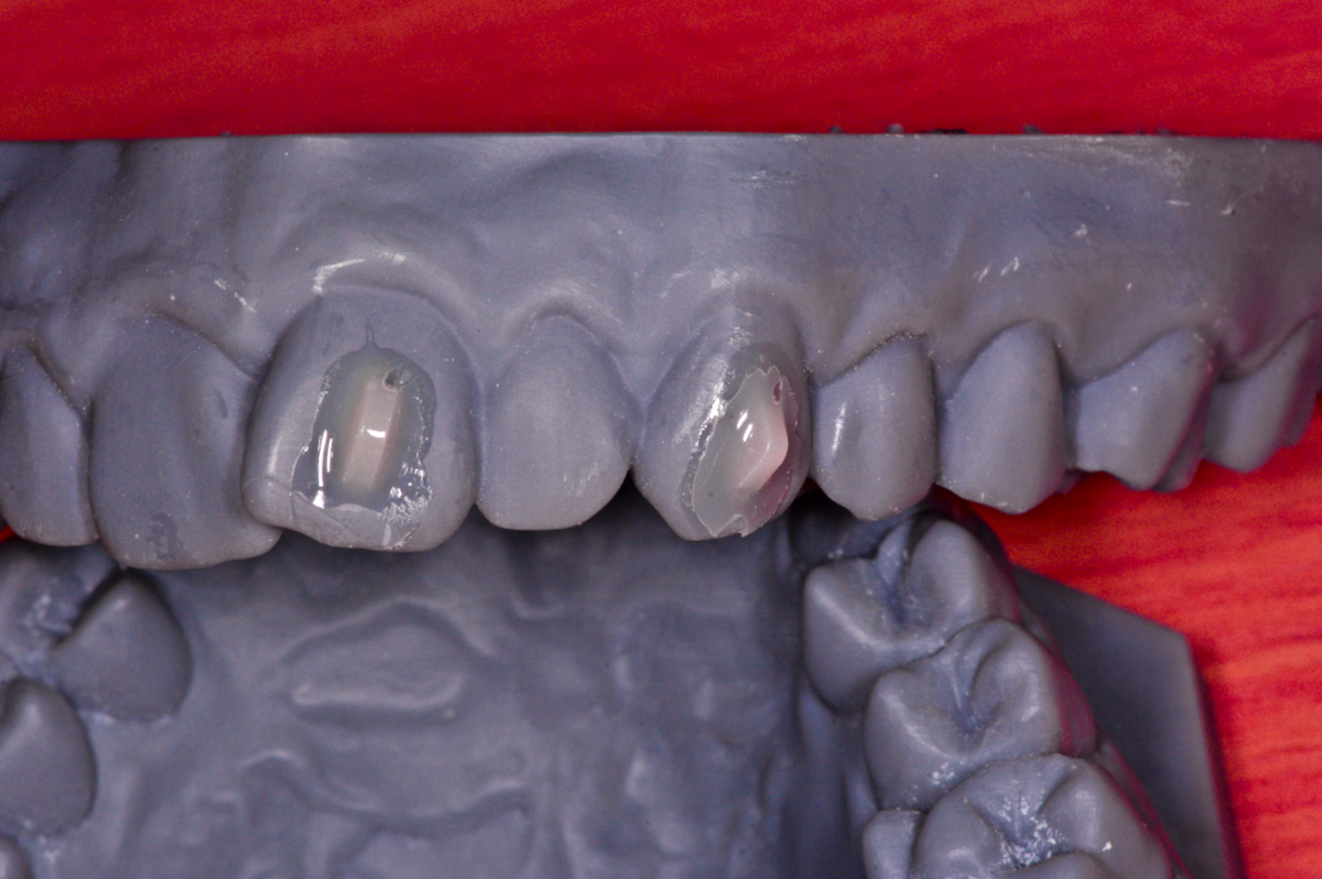 IAS Academy – ClearSmile Aligner Light i Inman Aligner Light