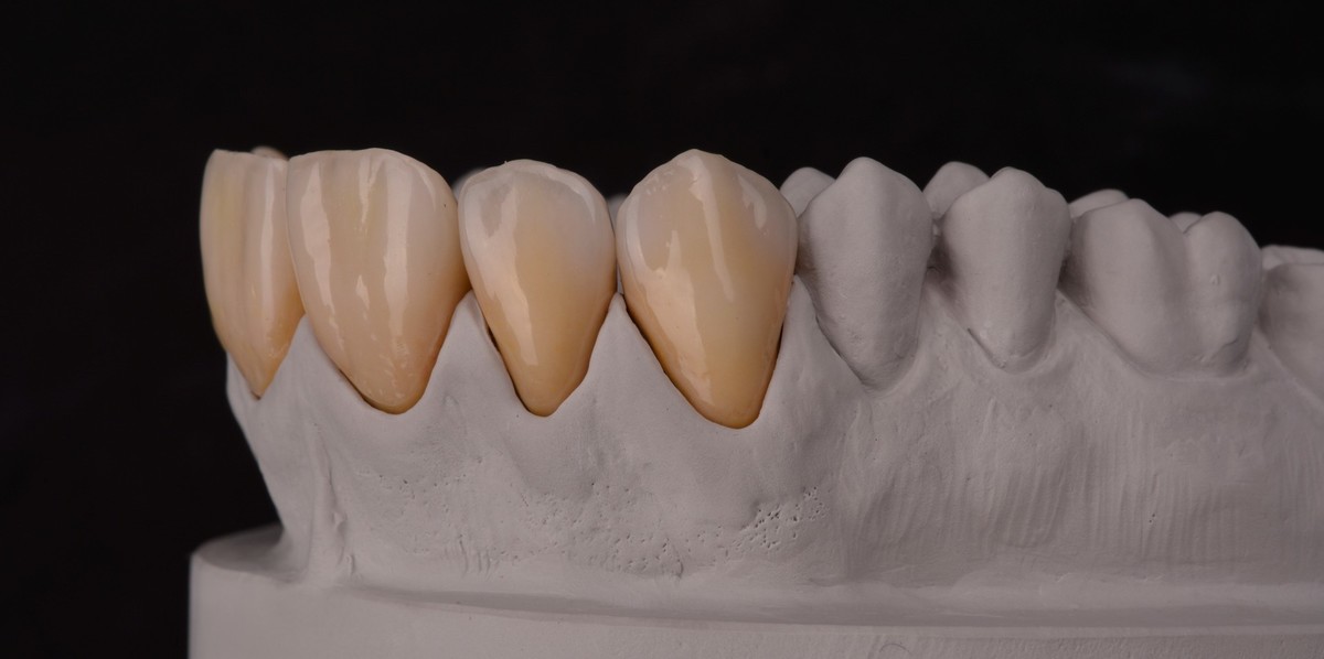 POPUNJENO - SUMMER DENTAL SCHOOL - Za mlade tehničare i učenike završne godine.